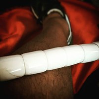 Fighting sciatica and fascial adhesion with a massage stick