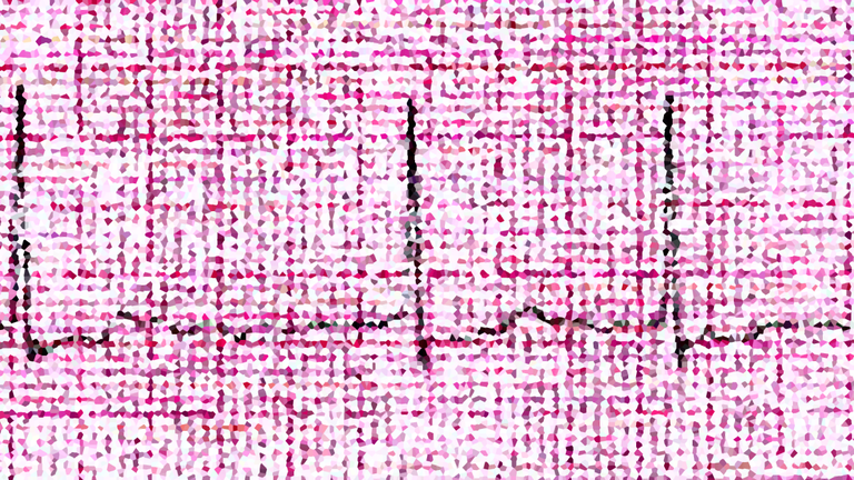 Atrial fibrillation (also called AFib or AF) is a quivering or irregular heartbeat (arrhythmia) that can lead to blood clots, stroke, heart failure and other heart-related complications. At least 2.7 million Americans are living with AFib.