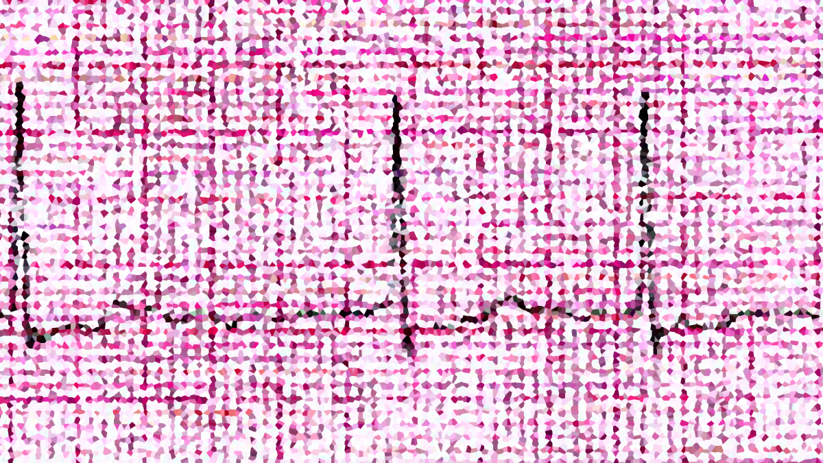 Atrial fibrillation (AFib)