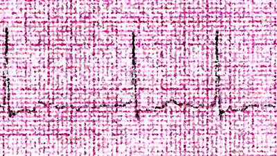 Atrial fibrillation (AFib)